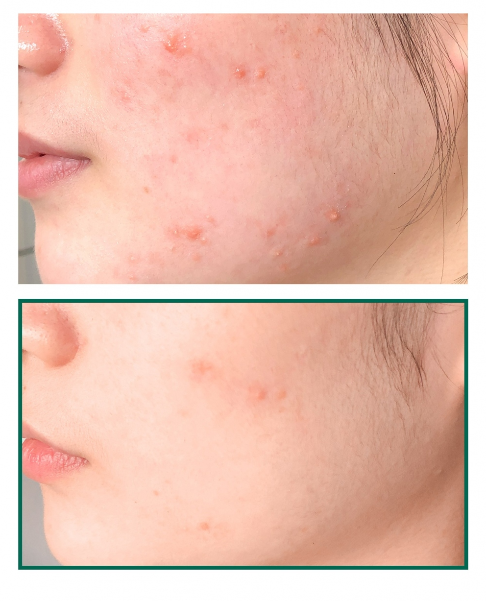 Some By Mi Mousse anti-acné miracle 30 jours AHA BHA PHA - My Korean Beauty